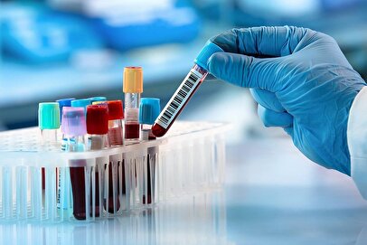 هشدار وزارت بهداشت برای عموم مردم / با انجام رایگان این آزمایش سرنوشت‌ساز سلامت خود را تضمین کنید