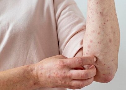 هشدار یک متخصص درباره شیوع بیماری عفونی در فصل بهار/ این نشانه‌ها را جدی بگیرید