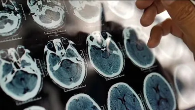 آلزایمر-در-کمین-جمعیت-ایران-پیش-بینی-دوبرابری-مبتلایان-تا-20-سال-دیگر